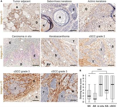 Upregulated integrin α11 in the stroma of cutaneous squamous cell carcinoma promotes skin carcinogenesis